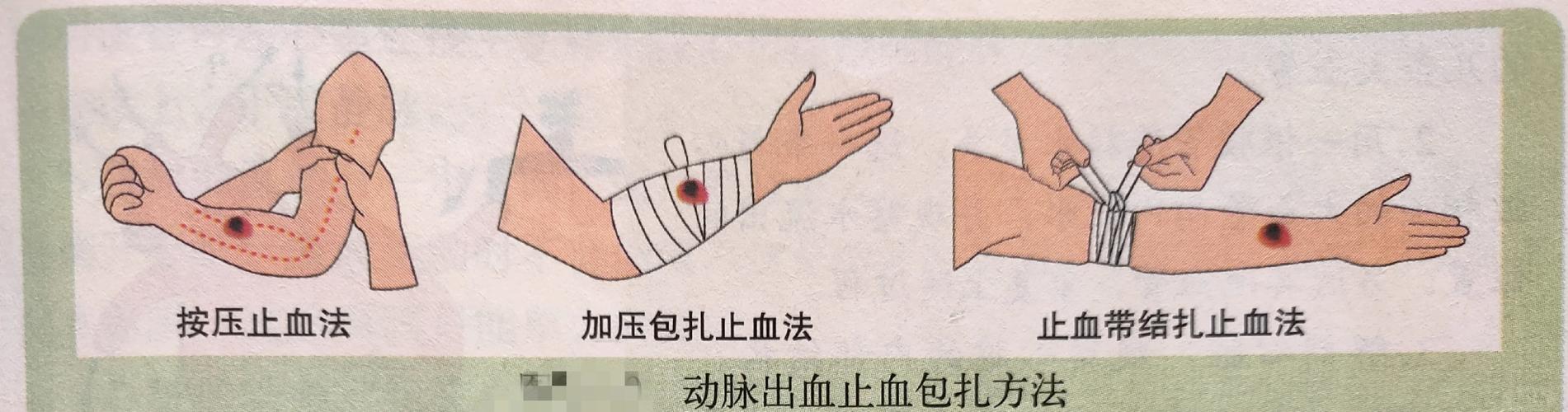 动脉出血怎么止血？动脉止血的正确方法步骤